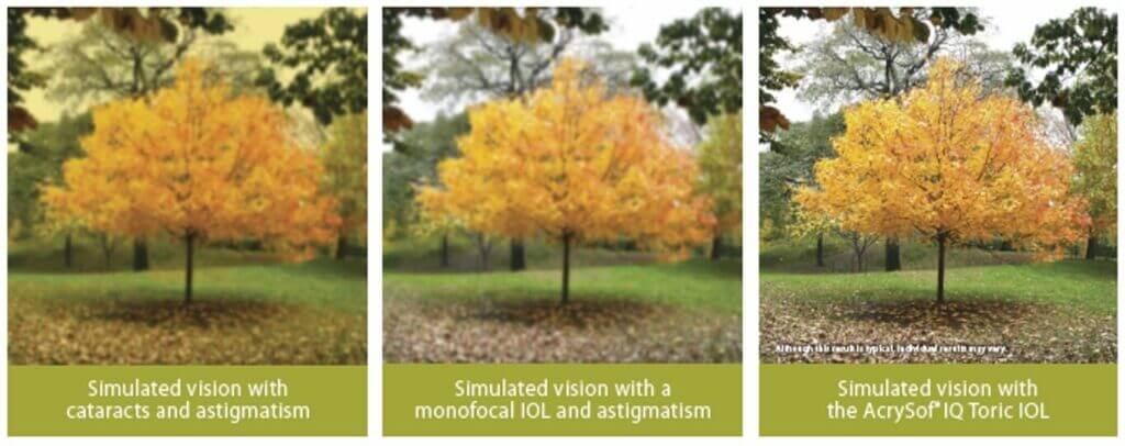 Simulated vision with cataracts, monofocal IOL and Toric IOL
