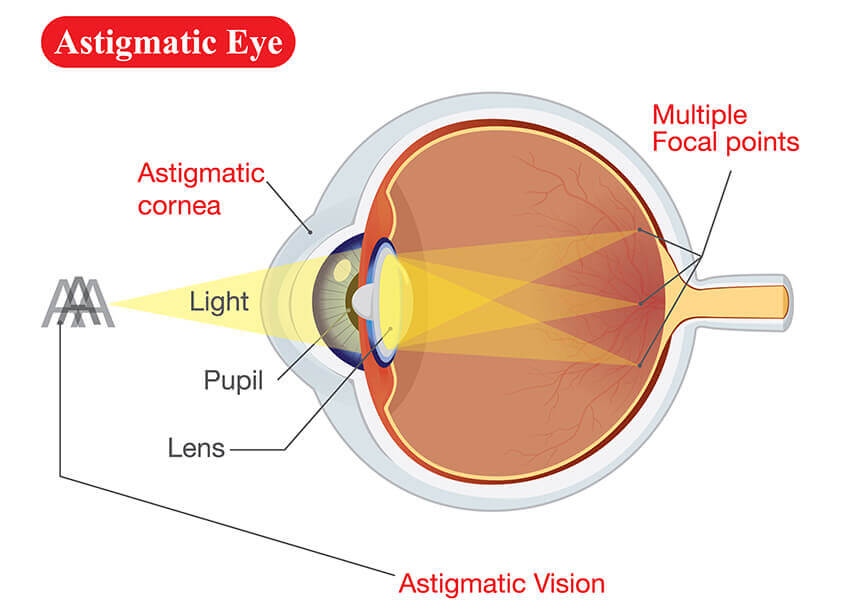 Diagram of Eye with Astigmatism