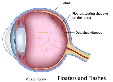 Floaters and flashes diagram