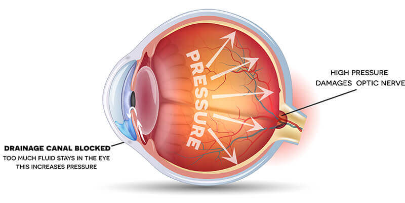 Glaucoma diagram