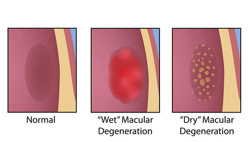 Normal and Diabetic Macula