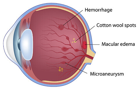 Nonproliferative diabetic retinopathy (NPDR) diagram