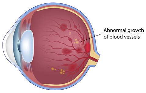 Proliferative diabetic retinopathy (PDR) Diagram